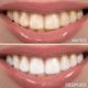 BLANQUEAMIENTO DENTAL CON ALTA TECNOLOGÍA 